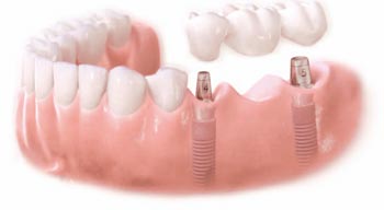 Zahn-Atelier Peter Biewer Badendorf: Kiefersituation für eine Implantatlösung