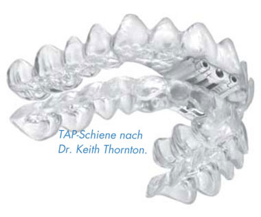 Zahn-Atelier Biewer Badendorf: Anti-Schnarch-Therapie mit der TAP-Schiene